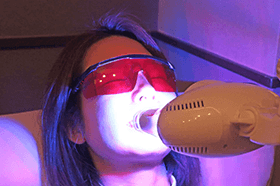 セルフホワイトニングコースのイメージ